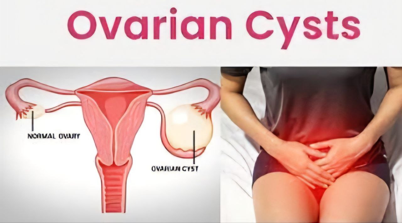 کیست تخمدان